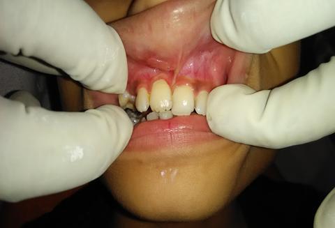 [11] Intrusion is such type of trauma, which is defined as the displacement of tooth into