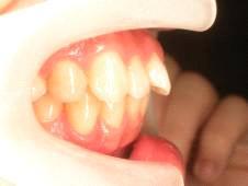 2 o upper incisor