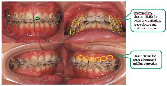 facilitate anterior intrusion for bite raising. Intrusion arch (bending by heat bender) can provide an intrusive force over anterior teeth for overbite reduction.