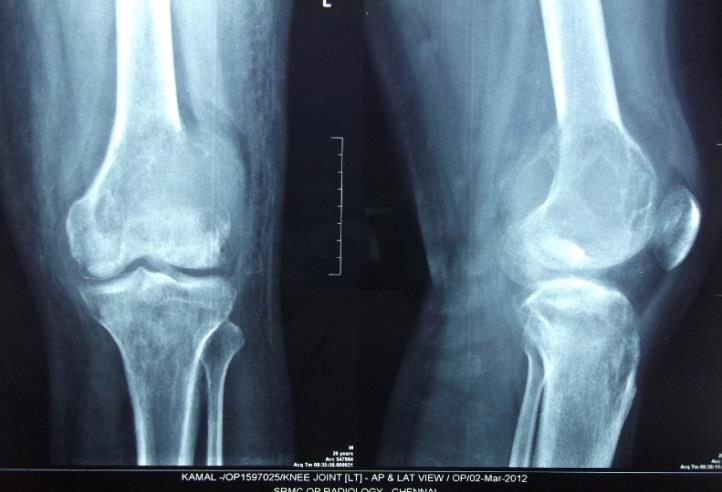 aggravating on bearing weight on the affected limb. There was no history of trauma to the affected knee or leg.