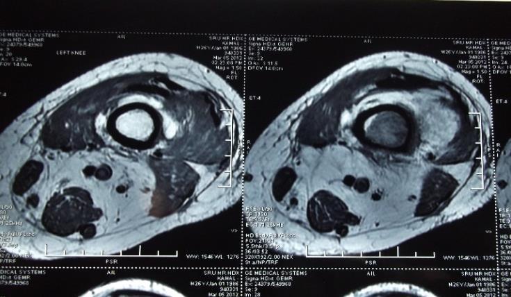 The patient was screened for metastasis with computed tomography of the brain and chest, ultrasonography of the abdomen and pelvis and there was no obvious evidence of any secondaries.