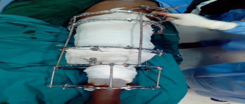 After multiple attempts, it was decided to remove the prosthesis as patient was having severe pain and unable to walk.