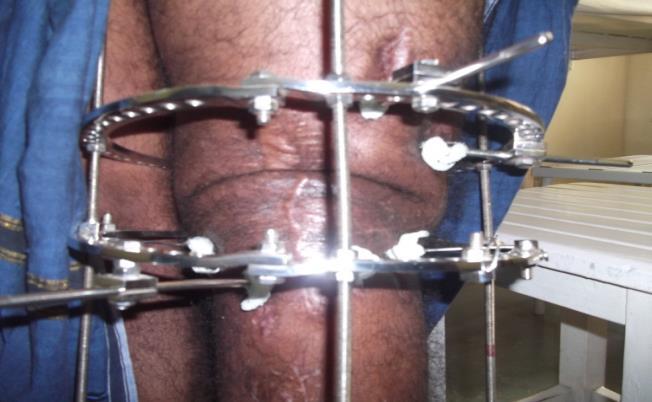 Figure 11: Soft tissue invagination at site of arthrodesis. Charnley compression clamps and external fixator were removed after fusion of the knee joint had occurred.