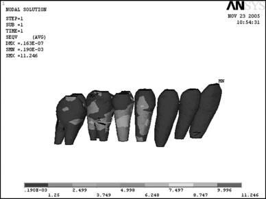 FEA OF MAXILLARY OBTURATOR WITH ATTACHMENT 3 The whole vertical load on all of the remaining natural teeth was 300N, out of which the load is distributed as, 20N on every anterior teeth, 40N on every