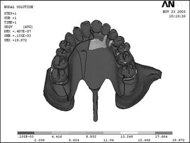 And the load on every tooth was evenly distributed. The non-defect sides of the Maxilla were designated as fixed regions with zero displacement.