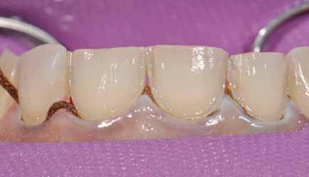 No caries was noted in the 12M region as suspected on radiographic examination.