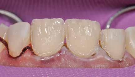 To mask out the visible transitional edge an opaque dentine shade, G-ænial Anterior AO2 (Opaque A2), was used in the incisal 2/3rds.