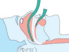 Mandibular advancement devices Oral appliances achieve a slight advancement of the lower jaw and tongue.