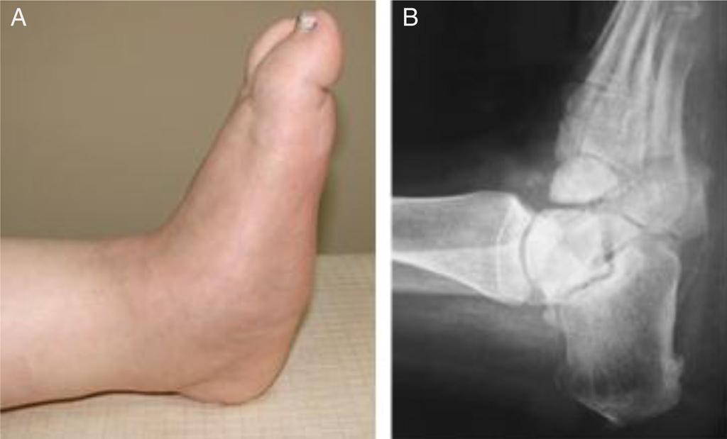 Mehmet F. Güven et al. sensation delays the recognition of bone injuries that may overload the insensate limb and leads to an active Charcot process (1315).