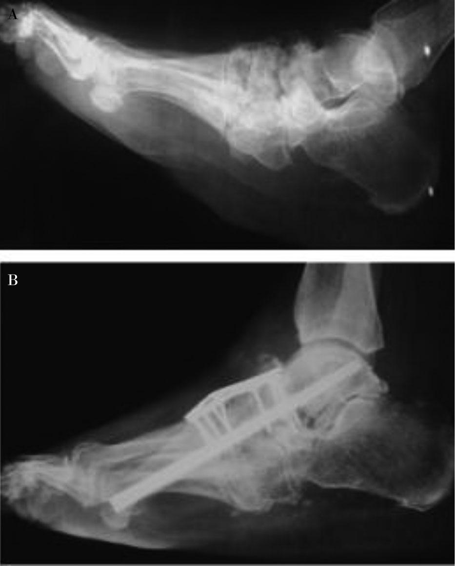 reported that Achilles tendon lengthening, in addition to osteotomy in CN patients with lateral midfoot ulcers, healed primarily with a rate of 38% (49).