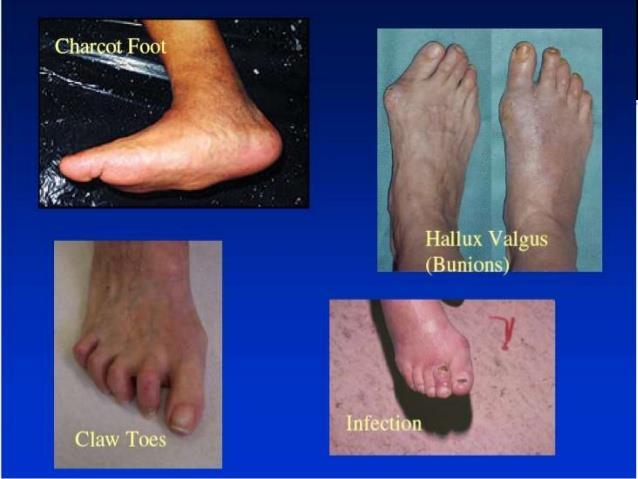 Foot Deformities and how