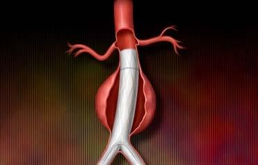 Preserve the Aortic