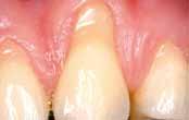 Gingival recession at tooth 13 before the treatment with mucoderm