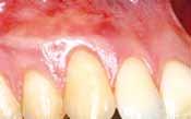 checked to fit into the defect; mucoderm is placed over the roots by