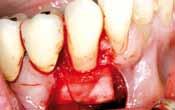 root Gingival tissue coronally repositioned, covering mucoderm and sutured in place