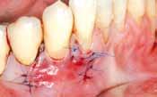 root The flap is coronally repositioned over the tooth root and the mucoderm and final