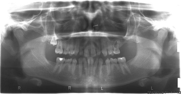 Tooth transplantation in rare syndromes Jensen & Album teeth are lost due to trauma. The transplanted tooth keeps the bone in place and prevents early implant treatment 4.