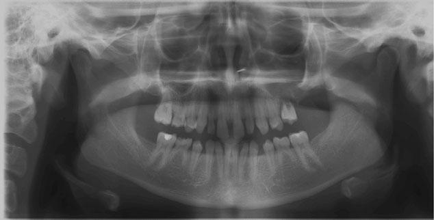 Jensen & Album Tooth transplantation in rare syndromes both the mandible and the maxilla, resulting from multilocular cysts composed of fibrotic stromal cells and osteoclast-like cells 9.