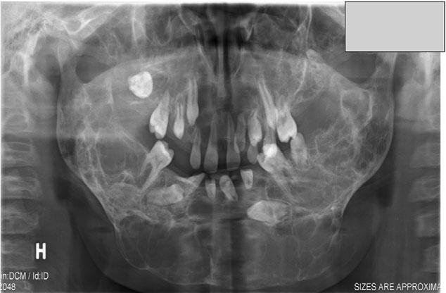 Jensen & Album Tooth transplantation in rare syndromes Figure 8 Case 2, OPG 1 year and 7 months after transplantation of 14 to the lower front. an advantage.