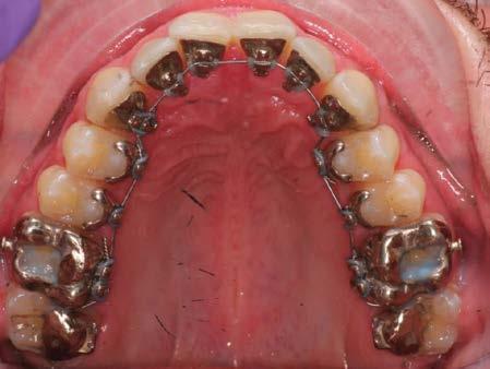 improve periodontal stability and smile esthetics.