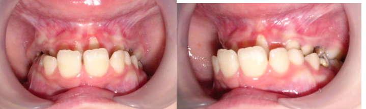 This adjustment led to the decreasing of the mastication need, to the alteration of maxillaries growth and to the increasing of anomalies frequency (1,2).