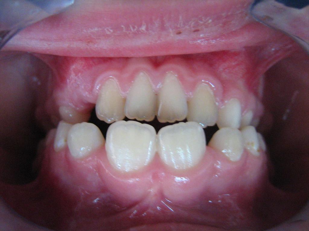 The reeducation of deglutition can be achieved by exercises or by tongue habit appliances, orthodontic appliances which prevent the tongue thrust.