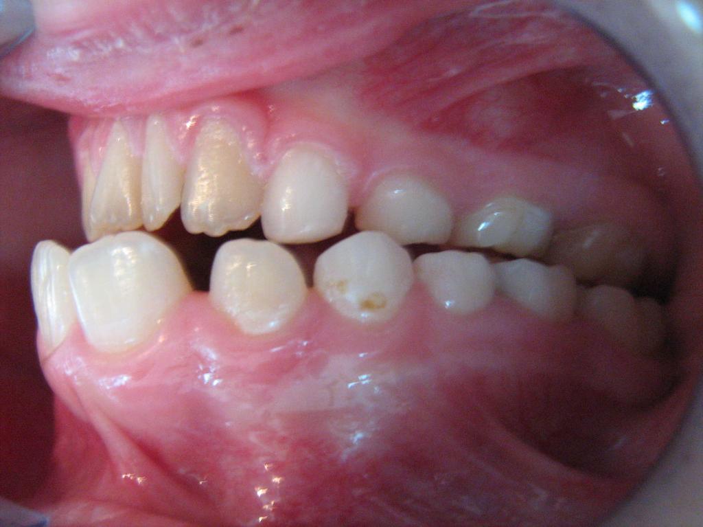 We present the case of a 9 years patient, with dysfunctional anterior open byte caused by tongue thrust.
