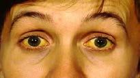 Jaundice The yellow color of skin, nail beds and sclera (white of the eyes) caused by deposition of bilirubin, secondary to increased bilirubin levels in the blood.