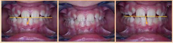 85 Cases Case No 1 It is a patient aged 8 years and 1/2, presenting a class I malocclusion that resides in right unilateral cross occlusion.