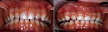 For this patient, the occlusion was unlocked by the addition on the dental occlusal surfaces of varying