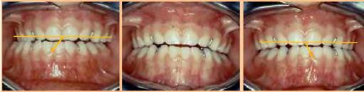 Case No 6 A 5-year-old patient with an endoalveolia with mandibular lateral gliding and preferential chewing on the left (Figure