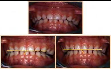 For the second case: We can appreciate the effectiveness of the tracks which favored the correction of the distoclusion.