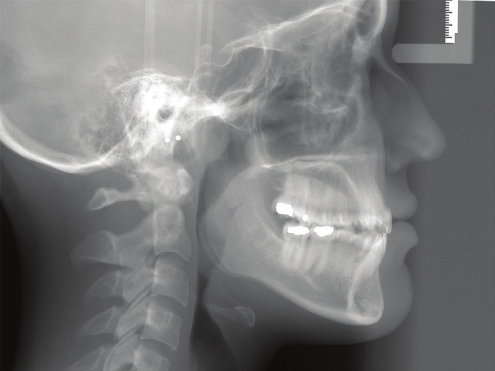 Case Reports in Dentistry 3 removed (Figures 5 and 6). She had both anterior and bilateral posterior crossbites.