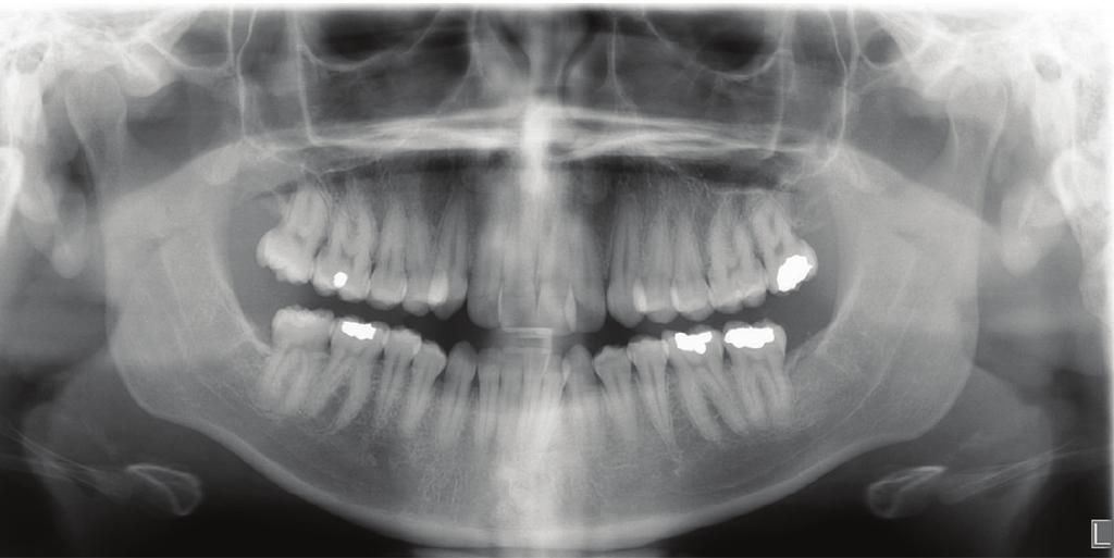 The cephalometric analysis indicated a retrusive maxilla and protrusive mandible (Figures 3 and 4). No growth was anticipated in this patient. Both TMJs were normal and no habits were apparent.