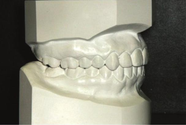 bone-anchored maxillary