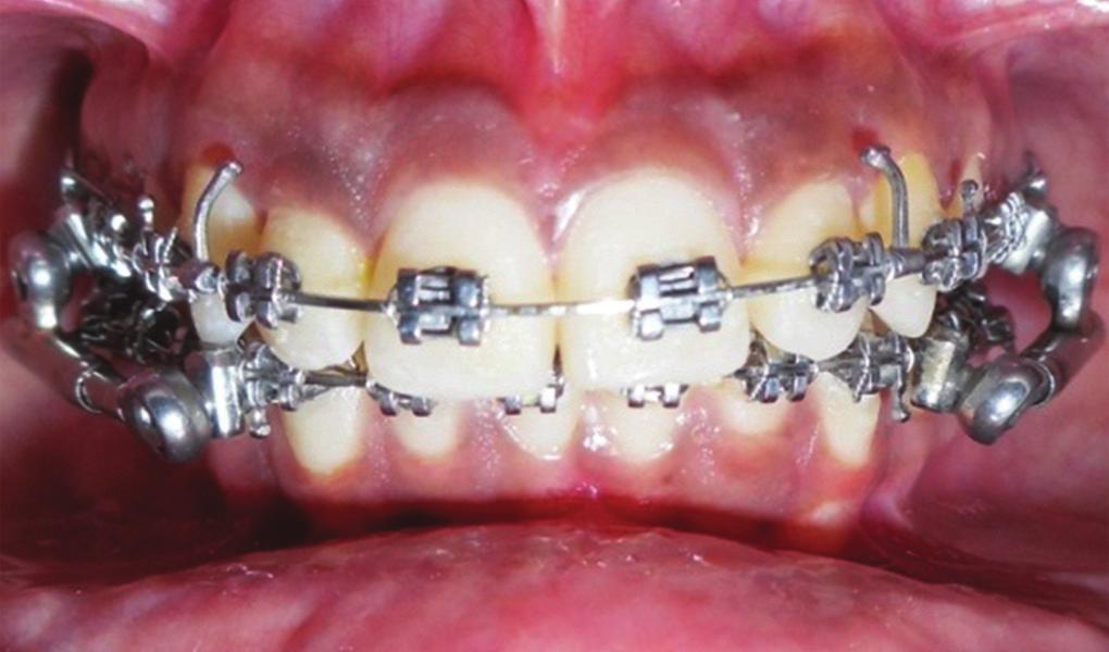 Nonextraction Management of Class II Malocclusion Using Powerscope: A Case Report Figure 4 Powerscope insertion using 3 mm shims available with the appliance to aid in midline correction.