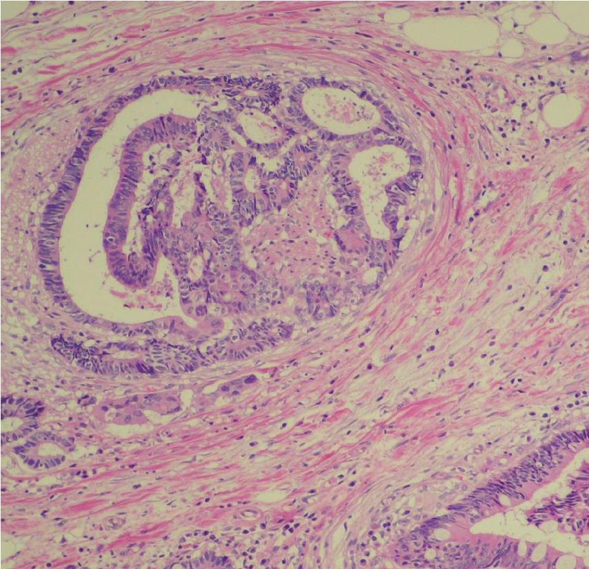 2 Case Reports in Surgery Figure 1: Histological examination of resected sigmoid colon cancer specimen. Histological examination revealed a well-differentiated adenocarcinoma.