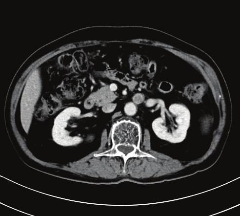 Abdominal CT demonstrated an enlarged isolated para-aortic lymph node (a)