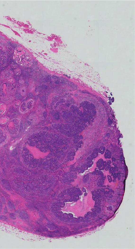 involved by well-differentiated adenocarcinoma with negative margins,