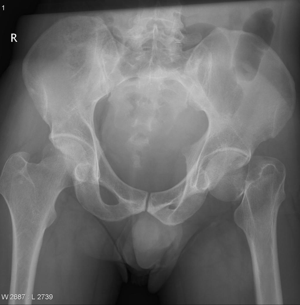 Hip fractures Danish epidemiological study (N=11,461): Compared +geriatric with standard care 30-day mortality: aor 0.69 (CI:0.54-0.88) No effect on Time-To-Surgery & Length Of Stay Kristensen et al.