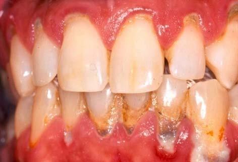 Periodontal Disease Chronic plaque at gumline Bacterial infection Inflammation Present in 50% of adults Can