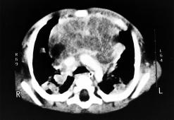 In addition, a few hypodense nodules were found in the right lobe of the liver (Figure 4). Under general anesthesia, CT-guided biopsy of the anterior mediastinal mass was done.