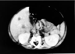 Enhanced CT scan of upper abdomen showed two ill-defined heterogeneous masses in the right lobe of the liver.