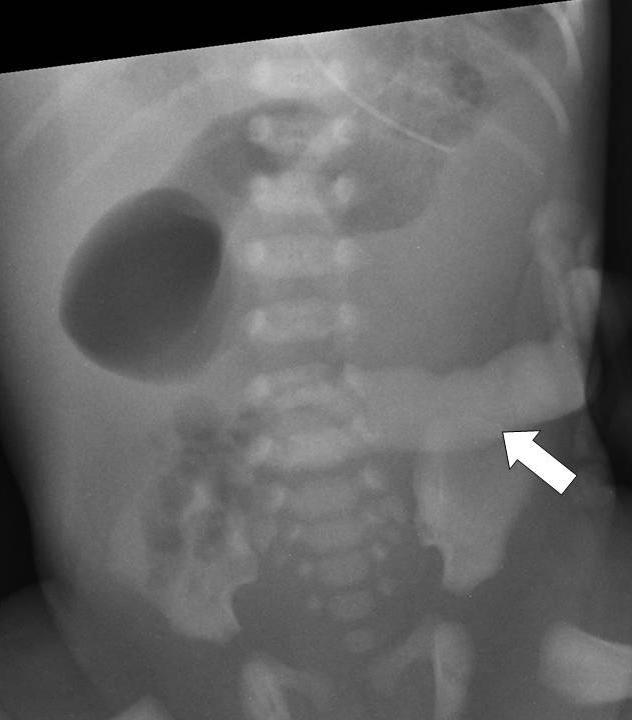 Figure 4: Abdominal upper gastrointestinal Gastrograffin contrast study of a three day old term male neonate who presented with bilious vomiting.