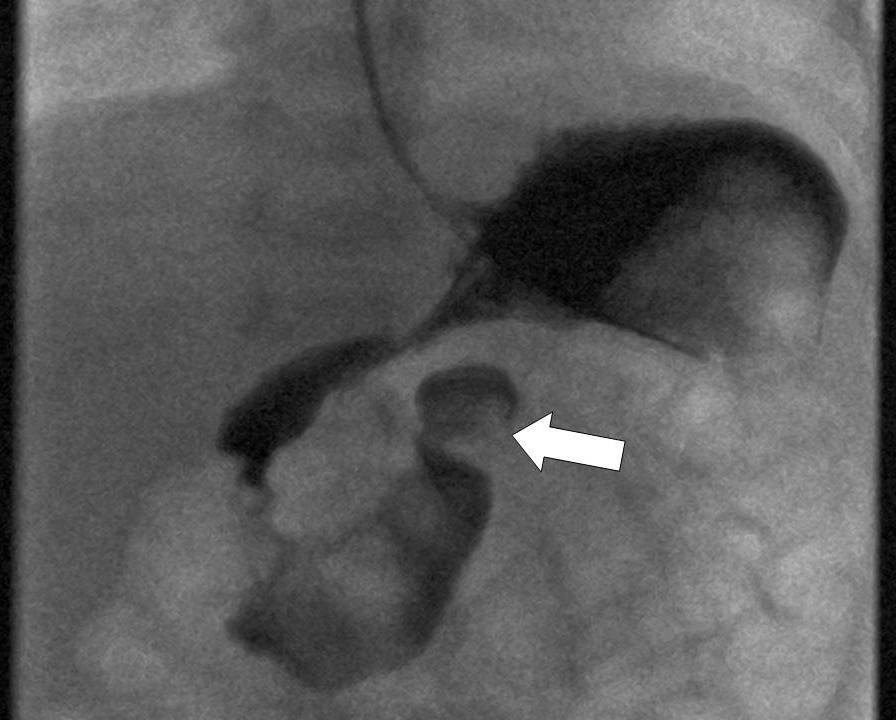 Duodenal dilatation is noted with gas in small bowel confined to right hand side. No colonic gas was evident.