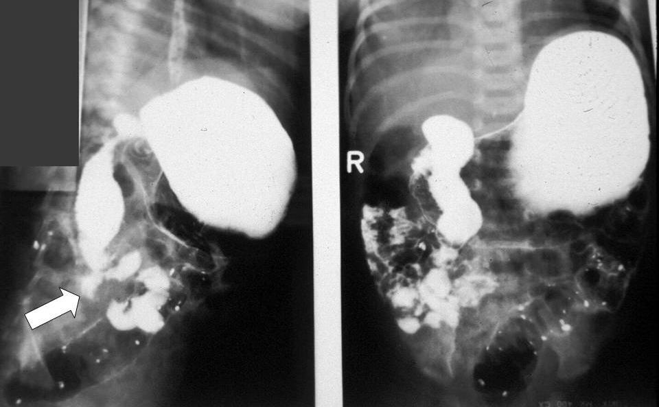 Figure 5: Upper gastrointestinal barium contrast study in a 4 day old female neonate who presented with bilious vomiting with associated abdominal distension demonstrating features of malrotation