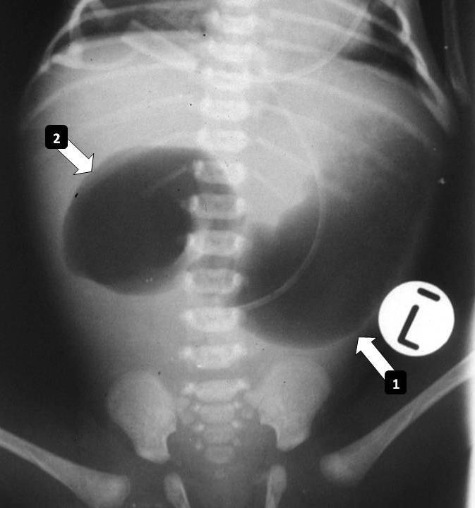 The AP view on the right shows the proximal small bowel to be lying to the right of the midline. The classic "C" of duodenum with the DJ flexure lying to the left of the midline is not seen.