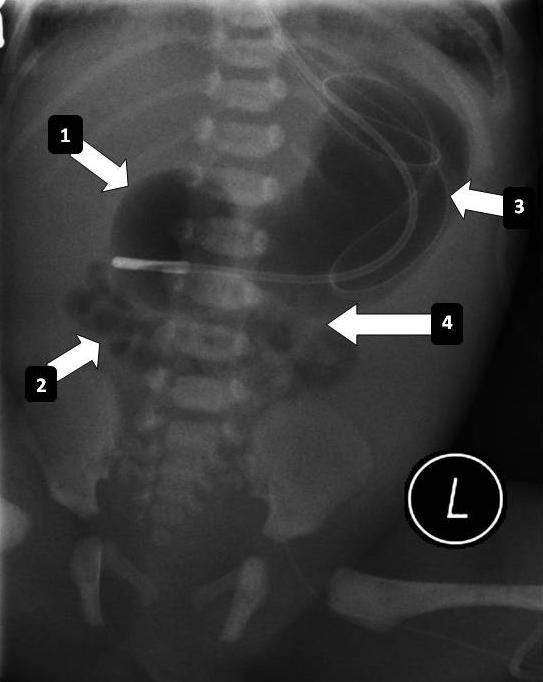Figure 7: Abdominal radiograph of a 1 day old male neonate with a duodenal web. The web is demonstrated by a distended proximal duodenum (arrow 1) and distal air present in the jejunum (arrow 2).
