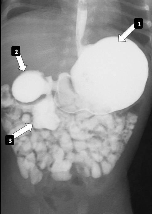 Figure 8: Upper gastrointestinal Niopam 360 contrast study in a 1 day male old neonate with a duodenal web.