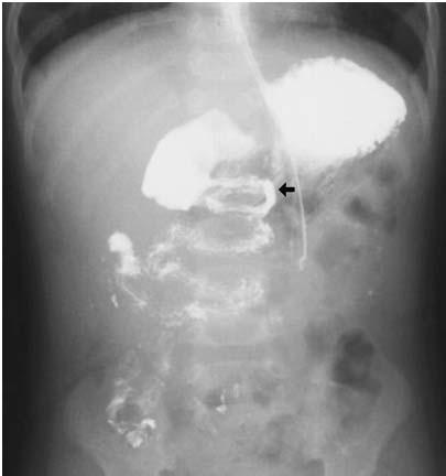 present with volvulus at <1 mo Bilious vomiting (90%) Distension,
